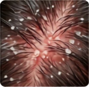 Dandruff,-Infection.